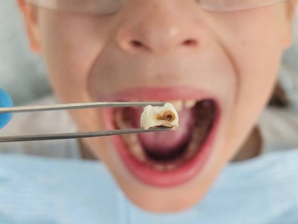 Best Emergency Root Canal Treatment in Philippi, WV